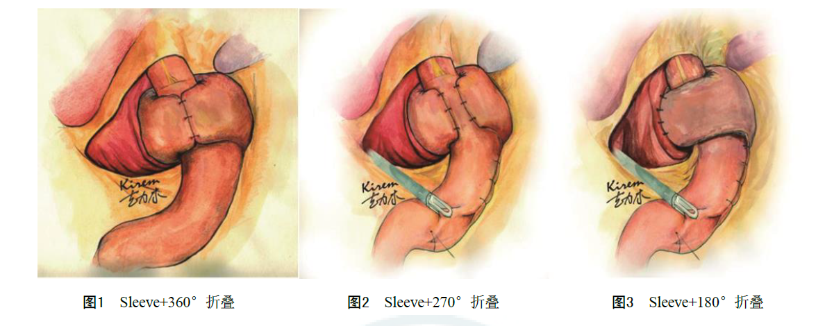 指南共识｜食管裂孔疝修补及抗反流手术规范微共识