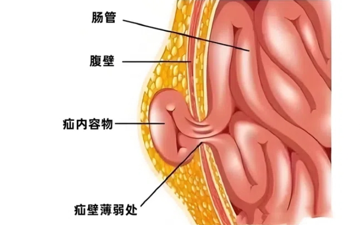 复杂腹壁疝微共识 | 腹壁疝合并皮肤软组织或补片感染